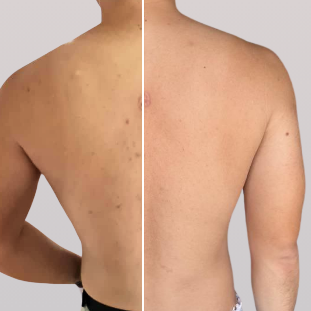 wilson before after consume cerayouth