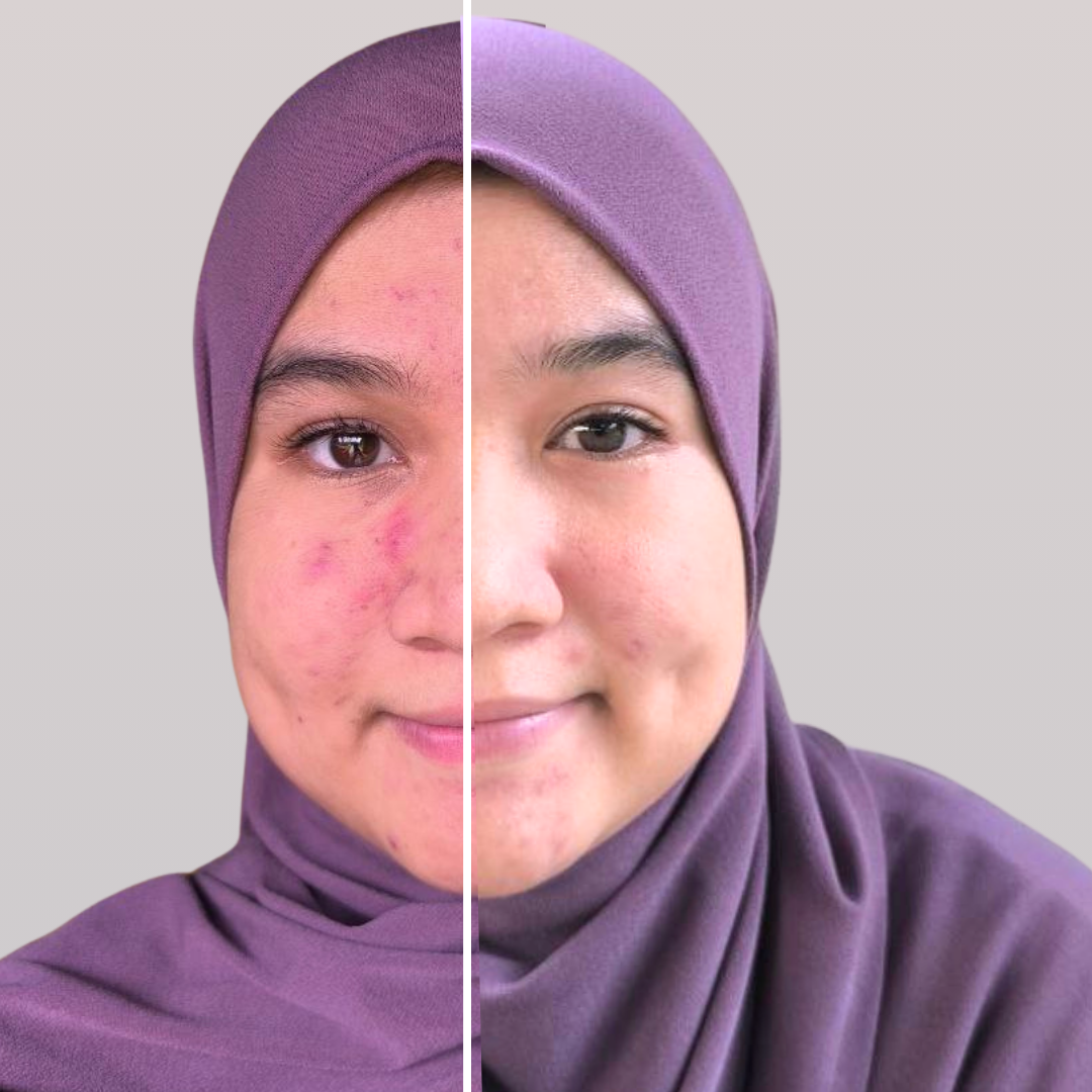 tinsyaz before after consume cerayouth