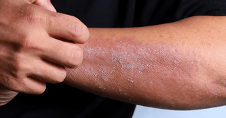 Skin Changes