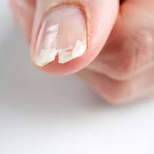 Brittle Nails
